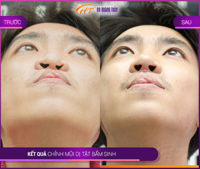 Kết quả phẫu thuật chỉnh hình mũi dị tật